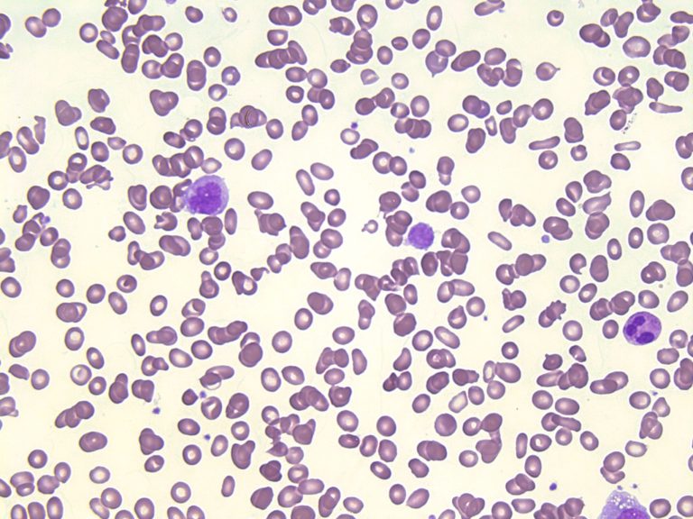 A data-driven network model of primary myelofibrosis