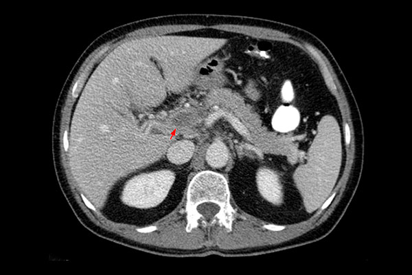 Imaging features of myeloproliferative neoplasms